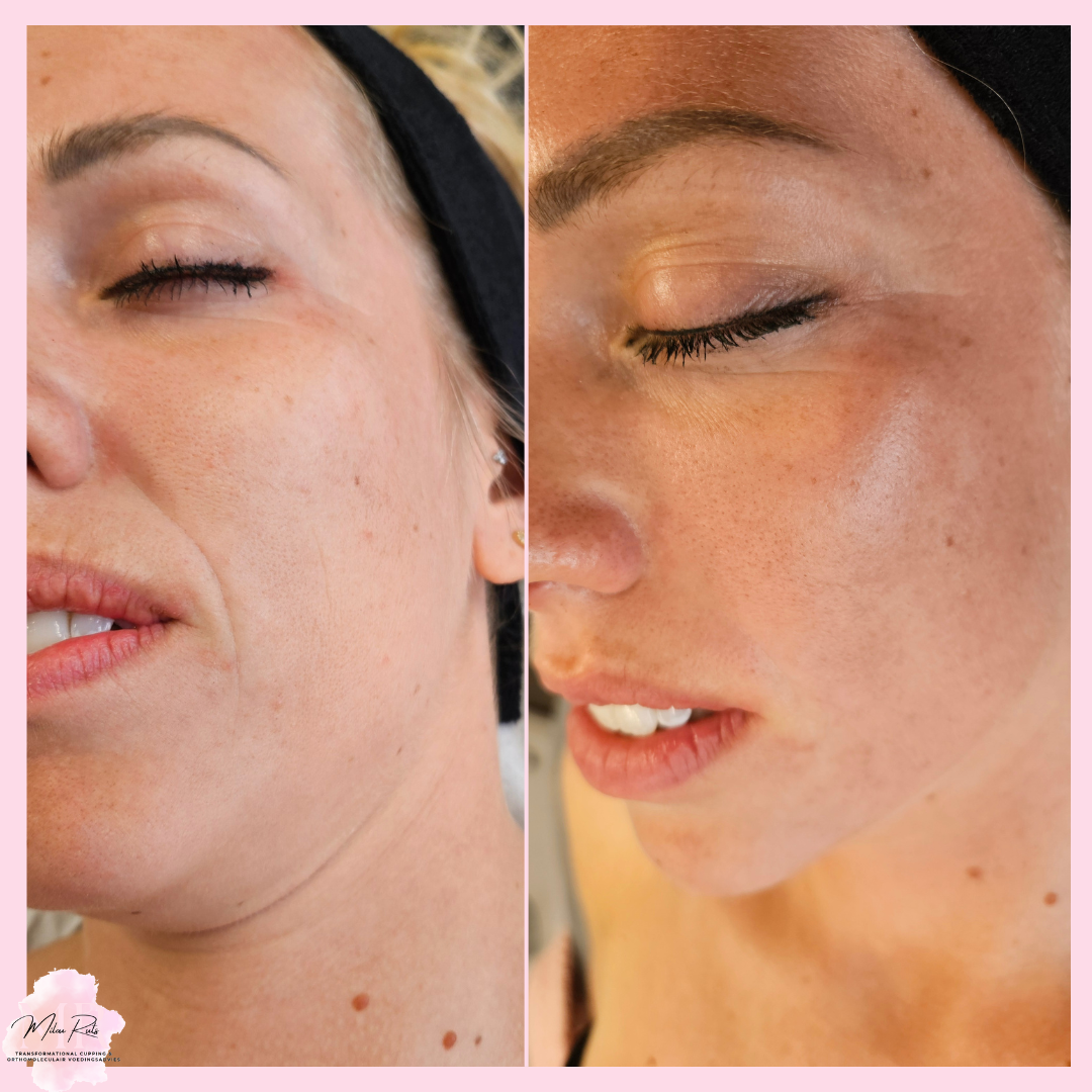 Gezichtscupping & bindweefselmassage