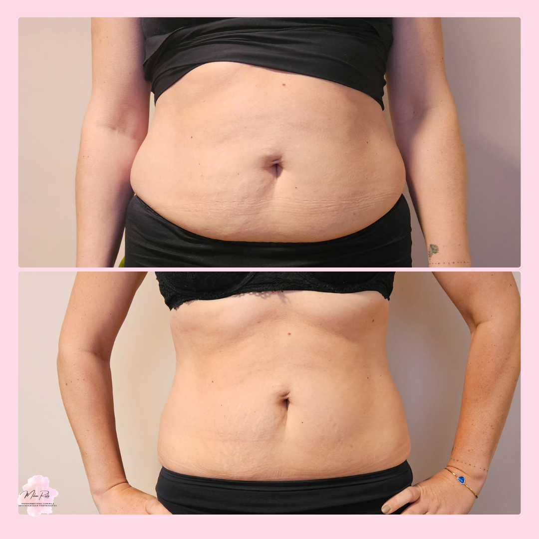 Transformational Cupping resultaat 3