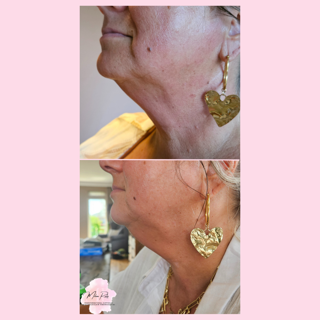 Gezichtsbehandeling resultaat 3